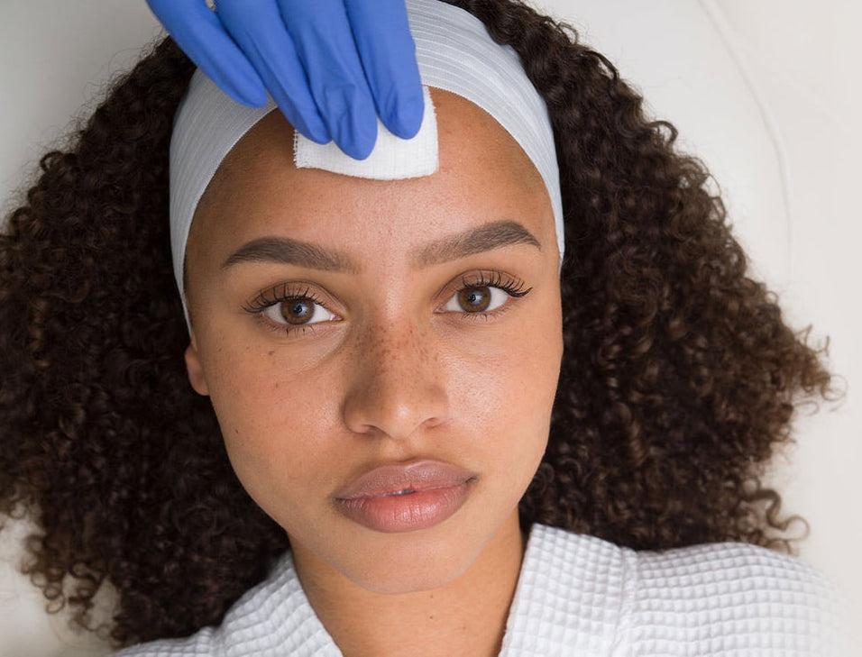 Chemical-peel-treatment