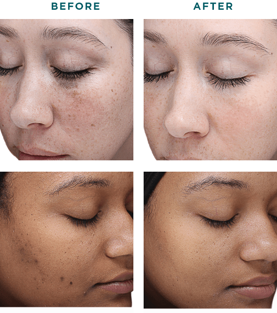 VI-Peel-Original-before-and-afters