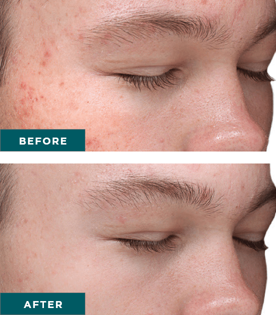 VI-Peel-Purify-before-and-after
