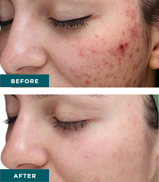 VI-Peel-Purify-with-Precision-Plus-before-and-after